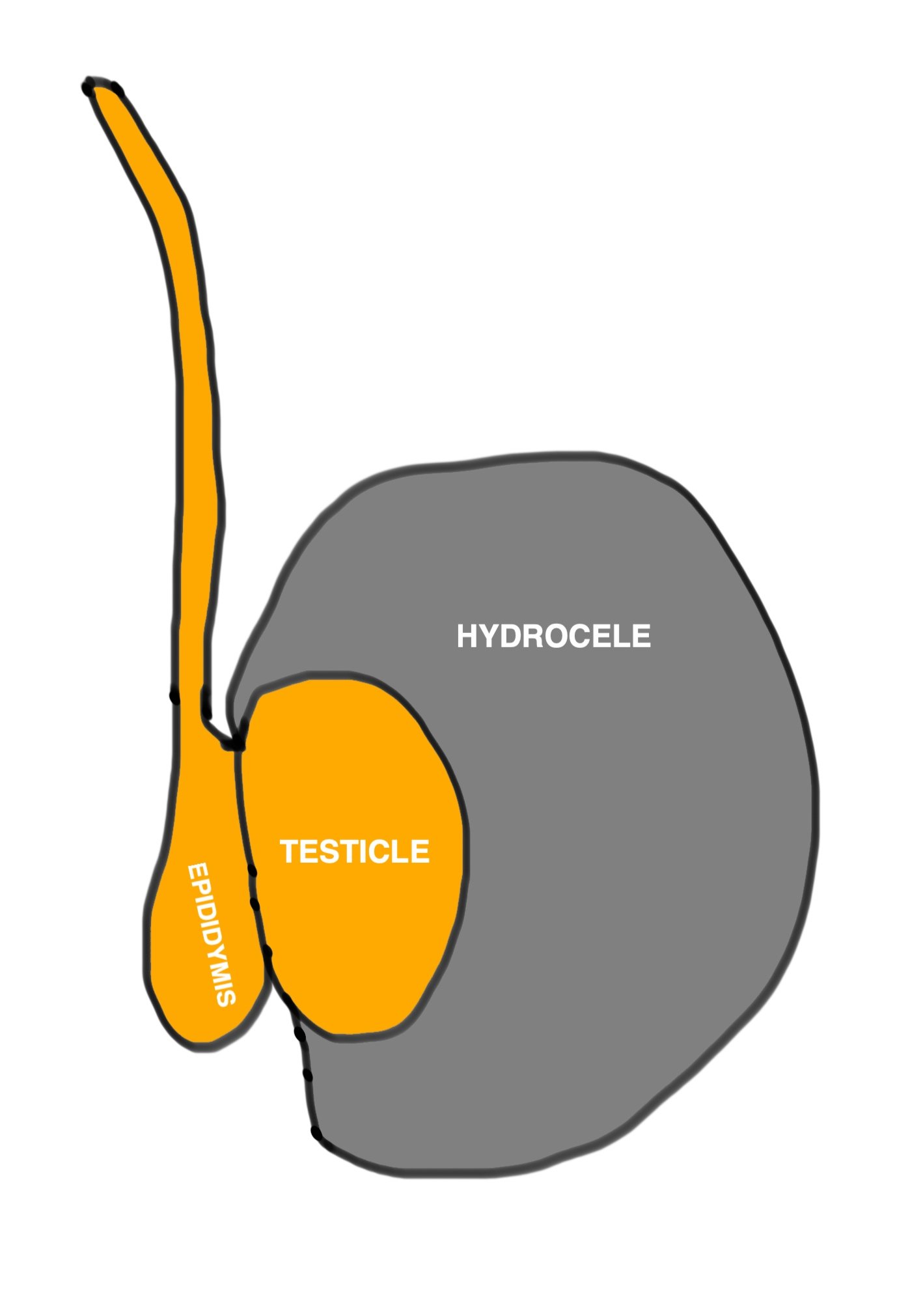 Drawing of Hydrocele