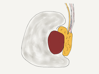 The hydrocele is a fluid filled sac around the testicle. It is attached to the testicle itself.