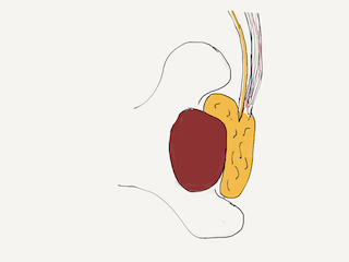 Removing the hydrocele involves opening the sac to allow it to drain. The entire sac cannot be removed because of its attachment to the testicle.