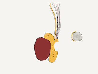 The cyst or spermatocele can be removed completely from the epididymis